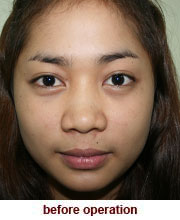 plastic_surgery_augmentation_rhinoplasty